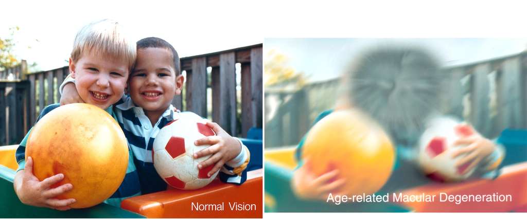 fbf697a2b5_27902_36828-comparaison-vision-normale-dmla-national-eye-institute-dp